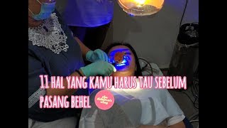 11 HAL YANG KAMU HARUS TAU SEBELUM PASANG BEHEL/KAWAT GIGI