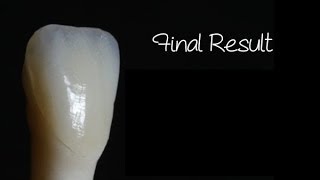 Composite Veneer Technique with Dr. Bob Margeas