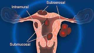 Que Son los Fibromas (Miomas) - Comor Curar los Fibromas, Tratamiento Para Fibromas Uterinos