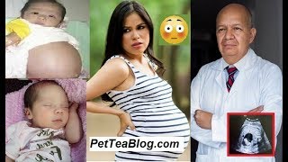 Baby Born PREGNANT with her Twin in Colombia ???