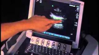 How to: Pneumothorax Evaluation with Ultrasound