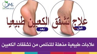 تشقق الكعبين | افضل واسرع طريقة في علاج تشقق الكعبين طبيعيا