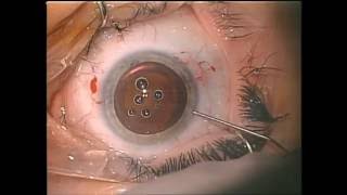 Ocular Surgery News Опубликовал видео операции проведенной Дмитрием Дементьевым
