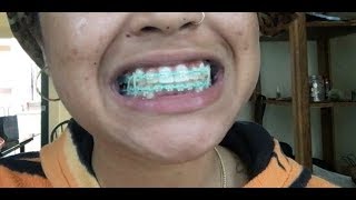 A B**** Got Power Chains! All About Adult Braces.