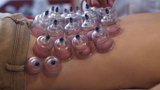 How to relieve lower back pain with cupping effectively