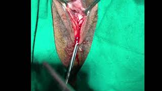 Hymenoplasty (Hymenal Reconstruction)