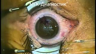 Фемто Супер ЛАСИК (Femto Super LASIK) - лазерная коррекция зрения