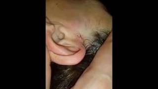 Squeezing big pimple