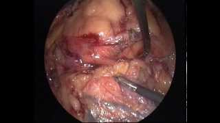 Laparoscopic ureterolithotomy