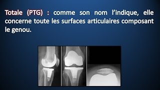 Rééducation d'une Prothèse Totale du Genou (PTG)