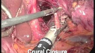 Laparoscopic Paraesophageal Hernia Repair