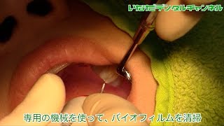 【千葉県 船橋市 歯医者】バイオフィルムをとってツルツルの歯を手に入れる_いなだデンタルチャンネル019（口腔ケアチャンネル）
