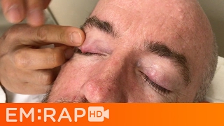 Chalazion Injection