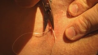 Skin tag removal WARNING! DRASTIC!