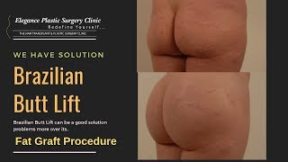 Brazilian Butt Lift by Dr Faisal Akhlaq | Elegance Plastic Surgery Clinic | Karachi, Pakistan