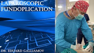 Laparoscopic fundoplication / Лапароскопическая фундопликация
