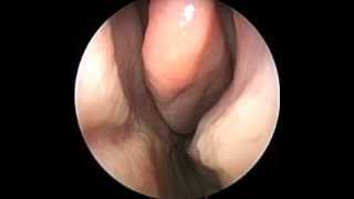 Treatment hematoma of nasal septum