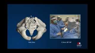 SI-LOK® Sacroiliac Joint Fixation System