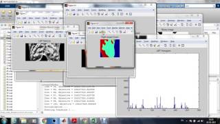 Breast cancer detection in thermal imaging using SVM classifier