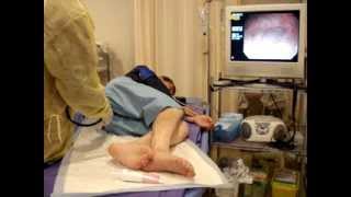 3'30" Total Colonoscopy:TCS:4'30" up to Ileum end