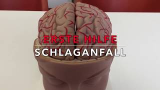 FAST-Test: Die rettende Regel beim Schlaganfall