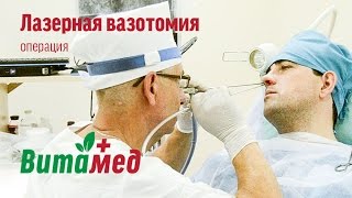 Лазерная вазотомия. Операция