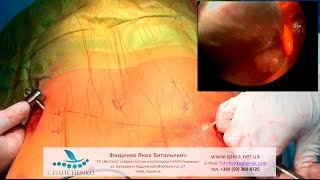 Реконструкция воронкообразной деформации грудной клетки по Нассу