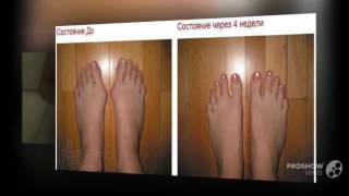 плоско вальгусная деформация стопы лечение

  - Valgus Pro по лучшей цене?