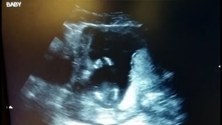 Watch a Baby Clapping in Rhythm During Ultrasound!