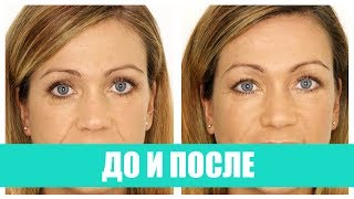 ДО и ПОСЛЕ/АНТЕС МЕД