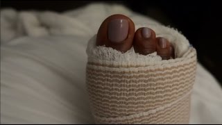 Day 2 Post Op Bunion Surgery Review
