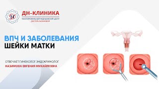 Папилломавирус как причина заболеваний шейки матки.Клиника Доктора Назимовой.
