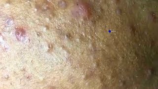 How To Remove Blackheads And Whiteheads On Face Easy #47 ✦ Dr Laelia ✦