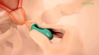 Установка пессария акушерского Dr.Arabin