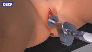 DEKA - MonaLisa Touch The New Laser Treatment for Vaginal Rejuvenation