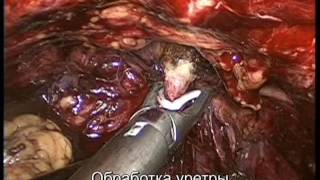 Лапароскопическая радикальная цистектомия, операция брикера, алгоритм 2016