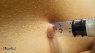 Можно ли вытащить клеща шприцом Эксперимент How to Remove a tick Поддубные