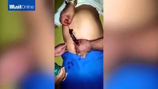 A Rat Get Pulled From A Man&rsquo;s Belly Button
