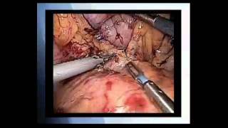 Laparoscopic Enucleation and Distal Pancreatic Resection: Andrew Gumbs, M.D.