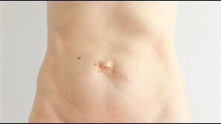 how to get rid of umbilical hernia without surgery