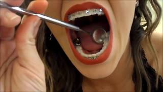 Braces mouth tour 2