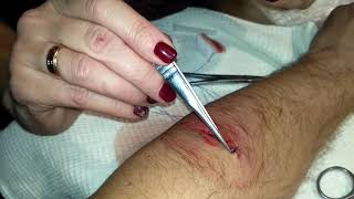 Зашивание  раны от циркулярной пилы в домашних условиях/Sewing a wound from a circular saw at home