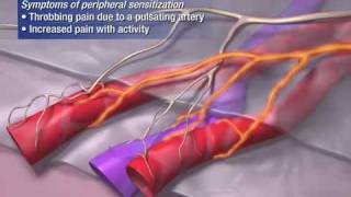 What is migraine?