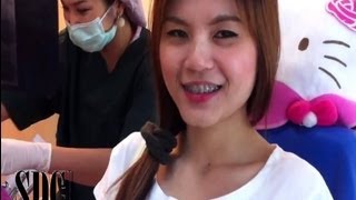 ฟันคุด ผ่าฟันคุด ก่อนผ่าฟันคุด