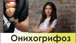 Аппаратный педикюр, утолщенный ноготь. Онихогрифоз. Трансляция из Instagram