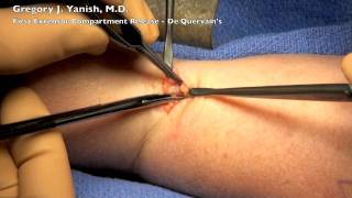 Wrist First Extensor Compartment Release -  De Quervains Syndrome