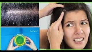 القضاء على قشرة الراس من اول استعمال ومنع تساقط شعرك وحبوب الراس والفطريات والحكة وحشرات الشعر