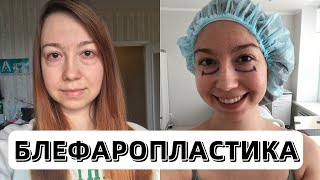Блефаропластика. Как я избавилась от мешков и отеков под глазами.