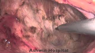 Lap Ultralow AR with ISR with Colo-anal anastamosis