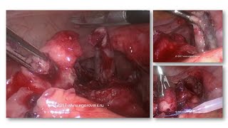 Острый гангренозный перфоративный аппендицит. Лапароскопическая аппендэктомия.